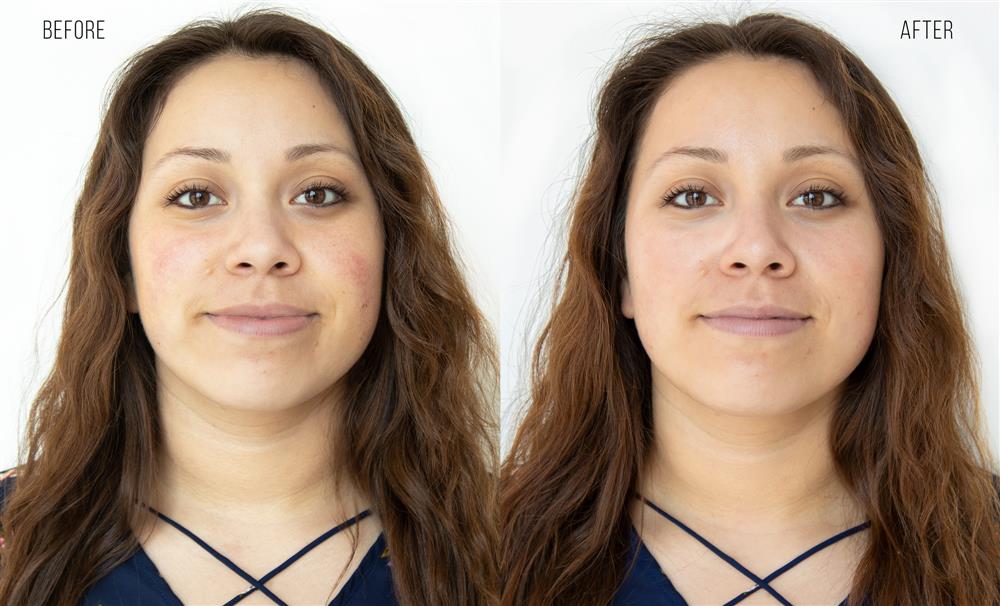 HydraFacial - Before & After for Red, Sensitized Skin
